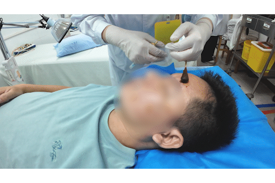 醒来“天塌了”<strong></p>
<p>门罗币软件</strong>！深圳一女子眼睛闭不上、嘴巴漏水！这些错误很多人会犯