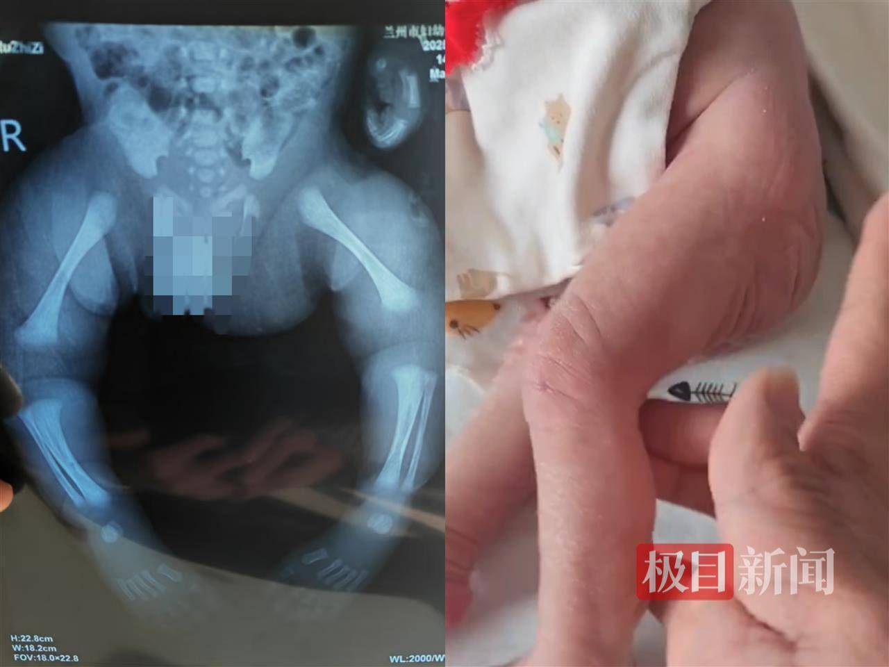 二胎出生查出先天性病症或落下残疾<strong></p>
<p>四五软件</strong>,残疾父母称医院产检漏检、未尽告知义务,医院及医调委回应