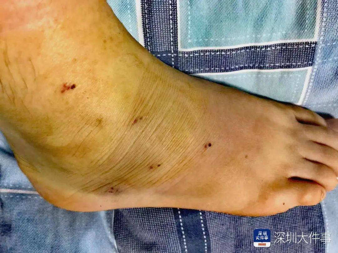 “一走路就痛”!女子脚踝受伤遭漏诊<strong></p>
<p>保证金</strong>,治了7年没好!深圳一医院被告上法庭