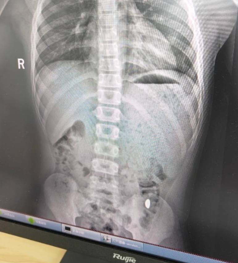 “熊孩子”误吞10克重金豆<strong></p>
<p>ERC20</strong>，妈妈：天天叮嘱他不要在外面拉屎