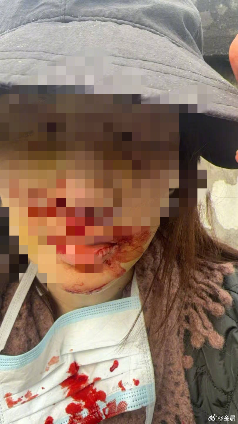 警方发布警情通报后<strong></p>
<p>比特币减半前都会大跌么</strong>，金晨晒脸部受伤照片并发文道歉