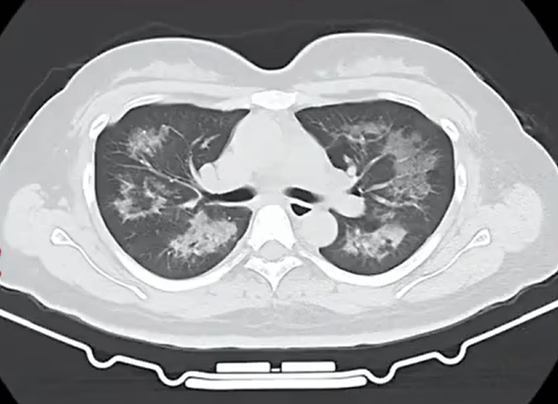 每天用2次<strong></p>
<p>华安创新基金</strong>，22岁女主播肺里长满阴影！很多人不注意