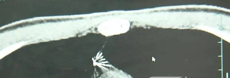 17岁小伙参军体检发现胸腔内有根5cm缝衣针<strong></p>
<p>偿债基金系数</strong>，父母回忆或是1岁时扎入，取出时已锈迹斑斑