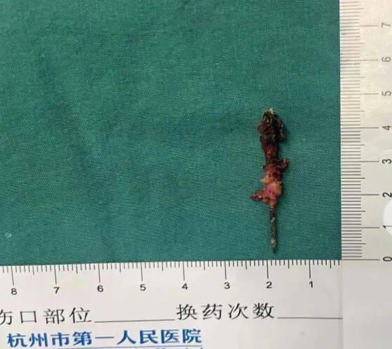 17岁小伙参军体检发现胸腔内有根5cm缝衣针<strong></p>
<p>偿债基金系数</strong>，父母回忆或是1岁时扎入，取出时已锈迹斑斑